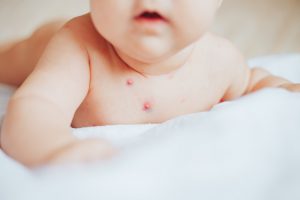 mother-holding-little-boy-with-red-pimples-home-chicken-pox-concept-varicella-sick-baby_93267-119
